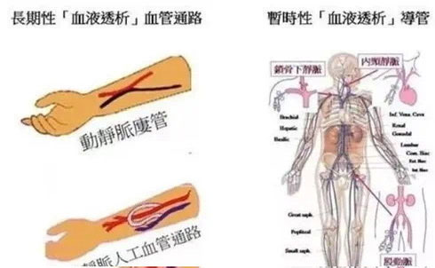血液透析如何防止内瘘堵塞？